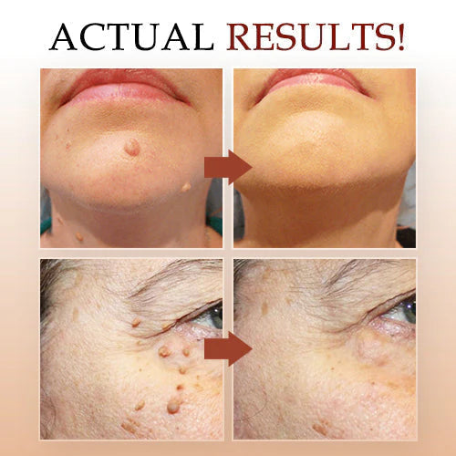 LOVILDS™ Tags & Moles Remover 🔥(Buy 1 Get 1 Free)🔥