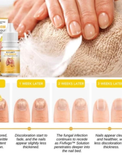 BeeVenom Nail Fungus Solution 10ml Each ( Buy 1 Get 1 Free )